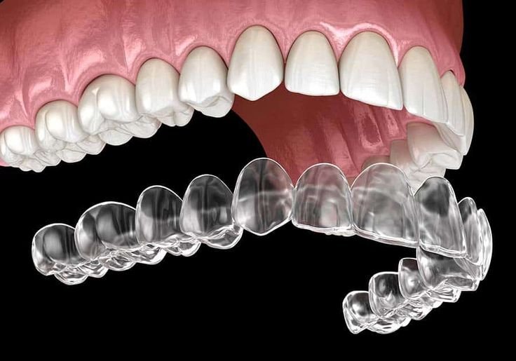How-Much-Is-Invisalign-Real-Cost-Breakdown-for-2026